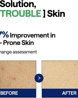 Teatree Trouble Pad - [brand_name]